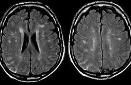 syphilis brain