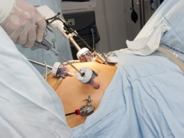 Flatulence to Blame for Failed Laparoscopic Procedure Laparoscopic surgery