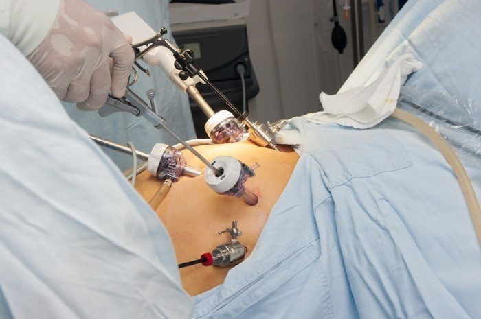 Laparoscopic surgery