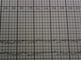 Vital Signs Much Worse After Implementing Anesthesia Automatic Electronic Records