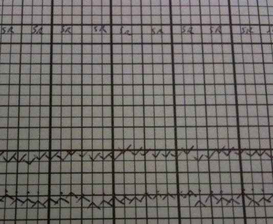 Vital Signs Much Worse After Implementing Anesthesia Automatic Electronic Records