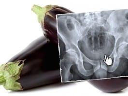 Genuine ‘Slipped and Fell’ Rectal Foreign Body Victim Stuns Experts