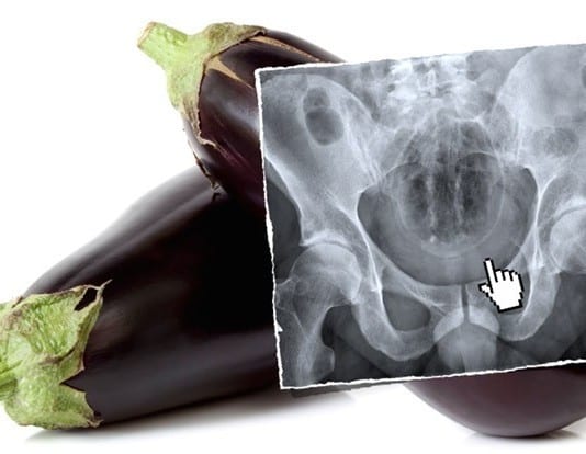 Genuine ‘Slipped and Fell’ Rectal Foreign Body Victim Stuns Experts