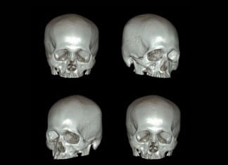 3D Head CT: The New Ultimate Selfie head ct