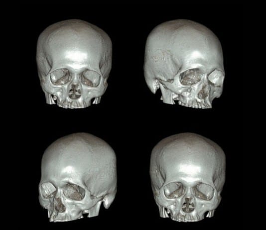 3D Head CT: The New Ultimate Selfie head ct