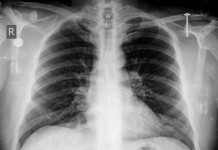 ‘Schmutz’ Added to List of ICD-10 Radiologic Diagnoses chest x-ray