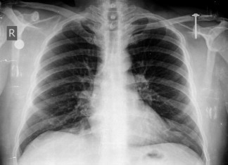 ‘Schmutz’ Added to List of ICD-10 Radiologic Diagnoses chest x-ray