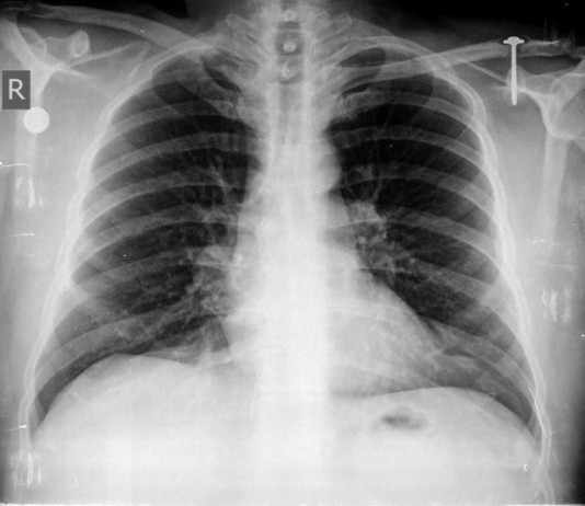 ‘Schmutz’ Added to List of ICD-10 Radiologic Diagnoses chest x-ray