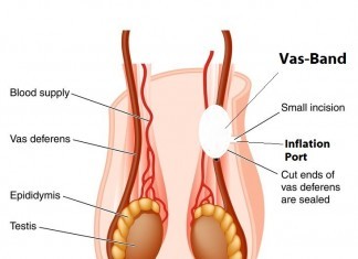 The Vas-Band: Vasectomies No More vasectomy alternative