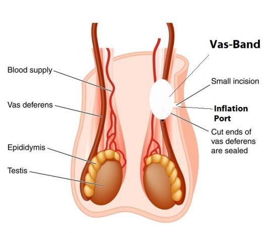 The Vas-Band: Vasectomies No More vasectomy alternative