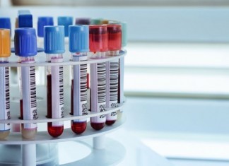 New Blood Test Measures Serum A**hole Levels lab test