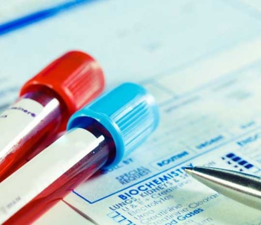 CBC To Be Replaced By Cheaper Incomplete Blood Count cbc