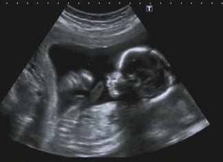 Surgeon Performs In-Utero Tommy John Surgery ultrasound