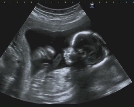 Surgeon Performs In-Utero Tommy John Surgery ultrasound