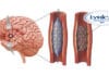 Lyrica-Eluting Stent for End Stage Fibromyalgia Sufferers
