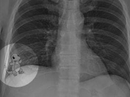 Radiologist Misses Right Lower Lobe Pokémon on Chest X-Ray