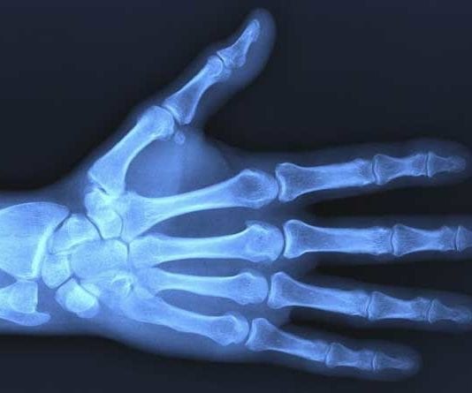 TSA Takes Wrist X-Rays for Poorly-Insured Passenger wrist x-ray