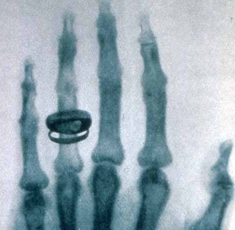 This Day in Medical History: Roentgen Invents Clinical Correlation Roentgen X-ray clinical correlation