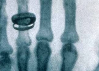 This Day in Medical History: Roentgen Invents Clinical Correlation Roentgen X-ray clinical correlation