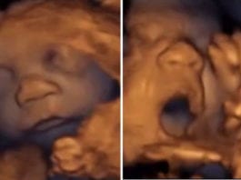 Beyoncé’s 3-Month Sonogram Reveals Twins Harmonizing In Womb sonogram