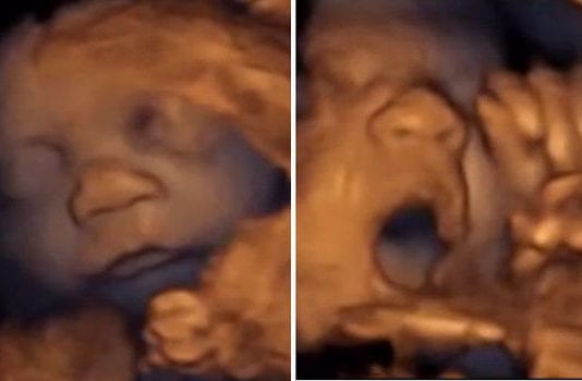 Beyoncé’s 3-Month Sonogram Reveals Twins Harmonizing In Womb sonogram