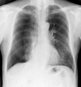 pneumothorax