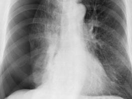 July Intern Really Excited to Cause His Very First Pneumothorax pneumothorax