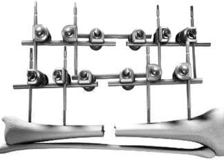 Breaking News: Orthopod Places Ex Fix on Ex Fix ex fixed ex fix