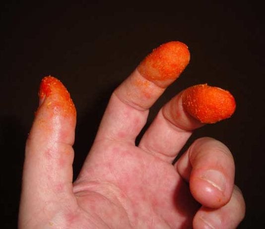 New Cheetos Finger Decision Rule for Abdominal Pain cheetos sign