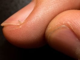 For Hangnails, The American Academy of Dermatology Now Recommends Hand Amputation hangnail hangnails