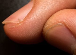 For Hangnails, The American Academy of Dermatology Now Recommends Hand Amputation hangnail hangnails