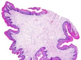 Dermatopathologist Unable to “Rule Out Pathology” on Skin Biopsy pathology