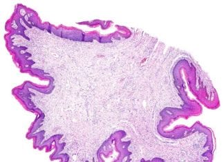 Dermatopathologist Unable to “Rule Out Pathology” on Skin Biopsy pathology