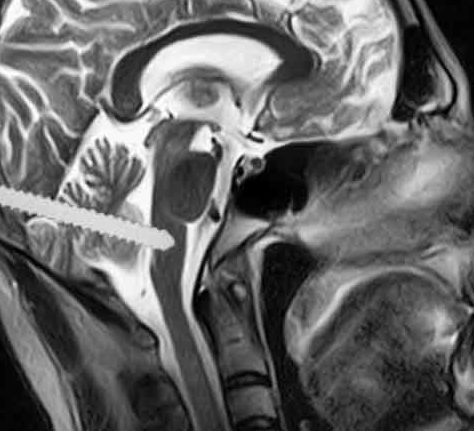 medulla oblongata intramedullary nail IMN