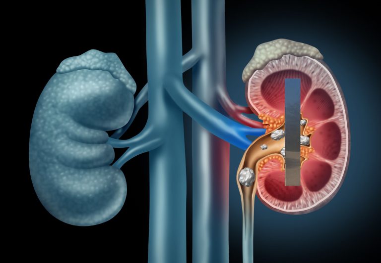 Another Monolith Found Within Patient’s Left Kidney