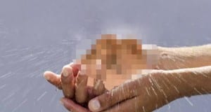 Patient Literally Sweats His Balls Off