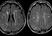 Vegan Patient Diagnosed With Organic Brain Disease syphilis brain