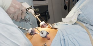 Flatulence to Blame for Failed Laparoscopic Procedure Laparoscopic surgery