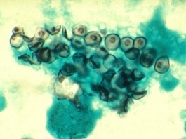 Carinii Sues Pneumocystis for Alimony After He Runs Away with His Secretary Jirovecii