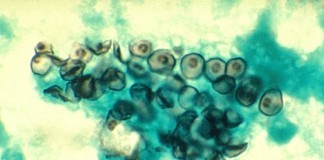 Carinii Sues Pneumocystis for Alimony After He Runs Away with His Secretary Jirovecii