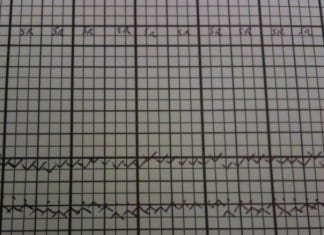 Vital Signs Much Worse After Implementing Anesthesia Automatic Electronic Records