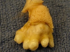 Tooth Fairy Refusing to Take Teeth from a Teratoma Teratoma