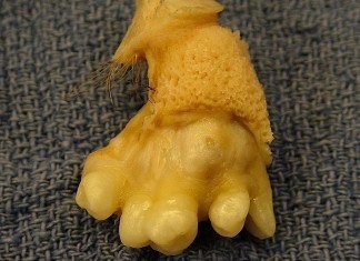 Tooth Fairy Refusing to Take Teeth from a Teratoma Teratoma