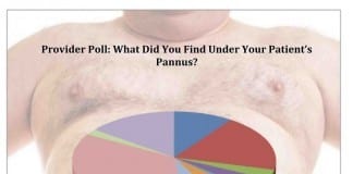 What Did You Find Under Your Patient’s Pannus? pannus reduction