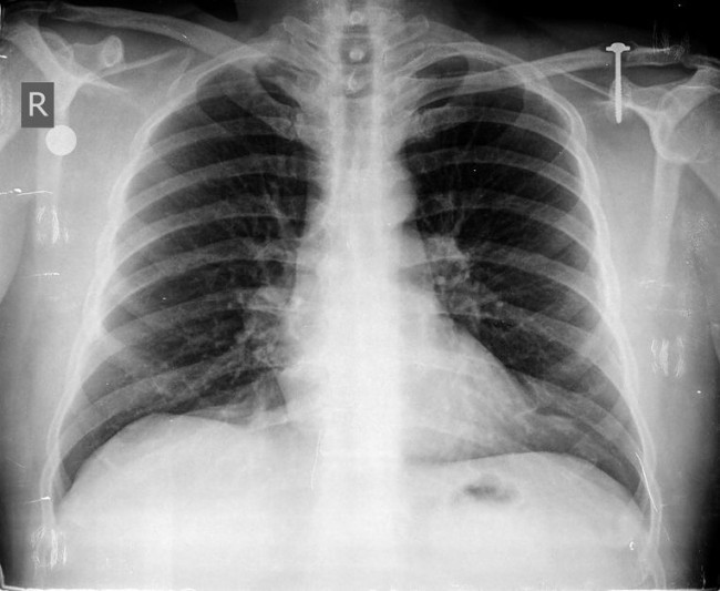 chest x-ray