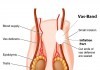 The Vas-Band: Vasectomies No More vasectomy alternative
