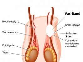 The Vas-Band: Vasectomies No More vasectomy alternative