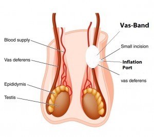 vasectomy alternative
