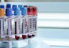 New Blood Test Measures Serum A**hole Levels lab test