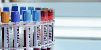 New Blood Test Measures Serum A**hole Levels lab test